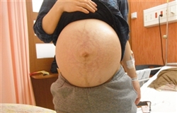 双子,妊娠,体重増加,腹囲,妊娠線双子　切迫早産　張り止め